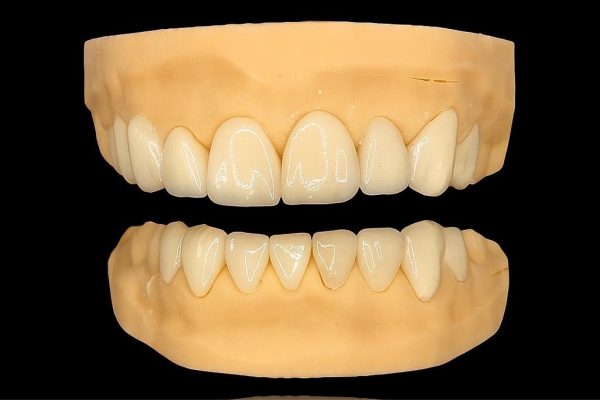 FACETTES DISILICATE DE LITHIUM